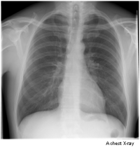 Photograph of a chest x-ray