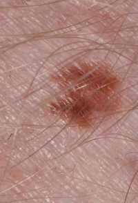 Melanoma that has developed from a suspicious dark mole