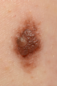Suspicious irritated mole found not to be melanoma