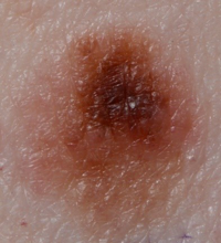 Melanoma from a mole with changing shape and colour