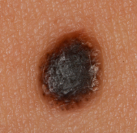 Melanoma that has developed from a long standing mole that is starting to spread