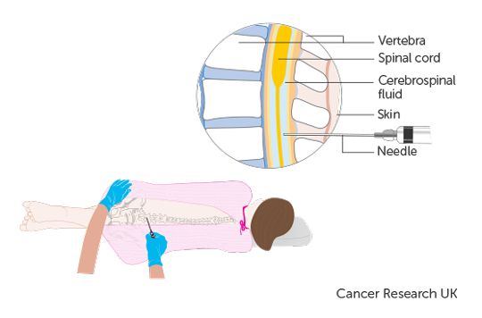 Diagram of a childs Lumbar Puncture