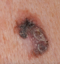 Melanoma from a new, odd-looking, growing lesion on the skin