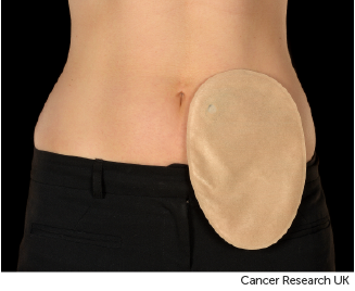 Photo showing one type of colostomy bag 