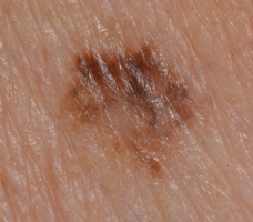 Photo of a superficial spreading melanoma