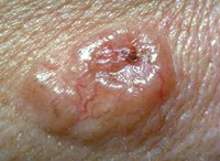 Photos Of Skin Cancer Cancer Research Uk