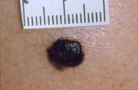 Diagram showing a darkening mole which could be a sign of melanoma 