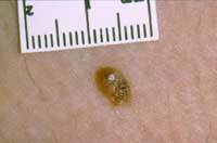 A photo of a mole that has an area of inflammation around it which could be a sign of melanoma skin cancer