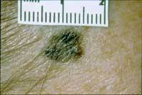 A photo showing a melanoma skin cancer with an irregular border.