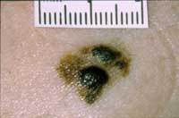 A photo of a melanoma that is spreading out from a normal mole.