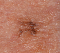 Photo of a lentigo maligna melanoma
