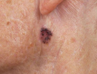 Photos Of Skin Cancer Cancer Research Uk