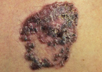 Photograph of pigmented basal cell cancer