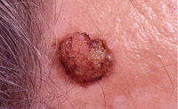 Photograph of squamous cell cancer