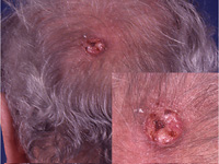 Photograph of squamous cell cancer on scalp